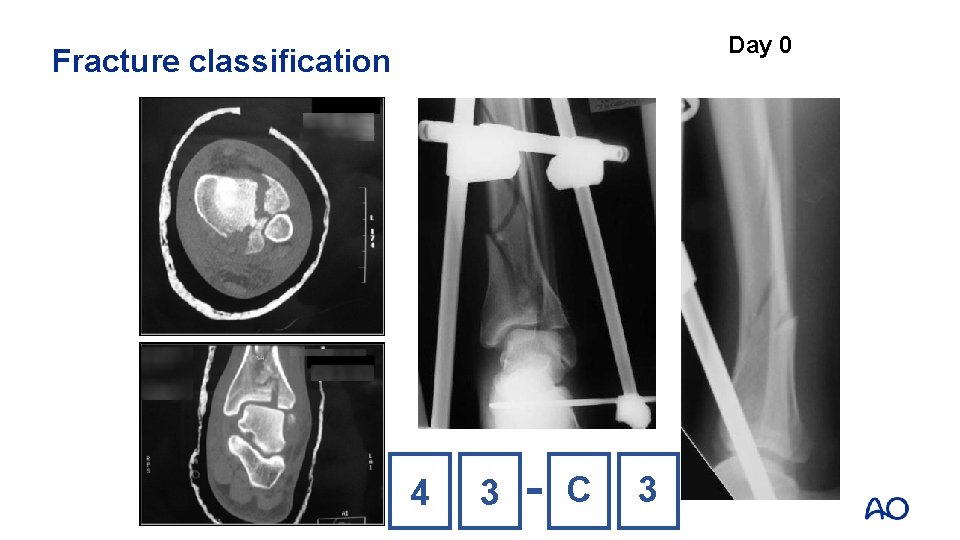 Day 0 Fracture classification 4 3 C 3 