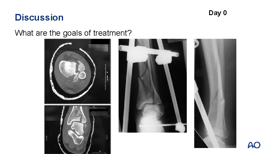 Discussion What are the goals of treatment? Day 0 