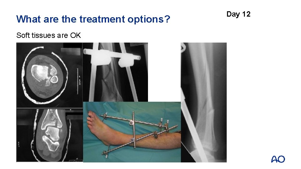 What are the treatment options? Soft tissues are OK Day 12 