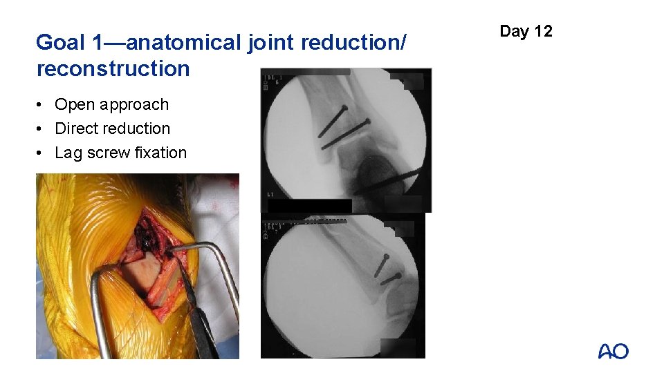 Goal 1—anatomical joint reduction/ reconstruction • Open approach • Direct reduction • Lag screw