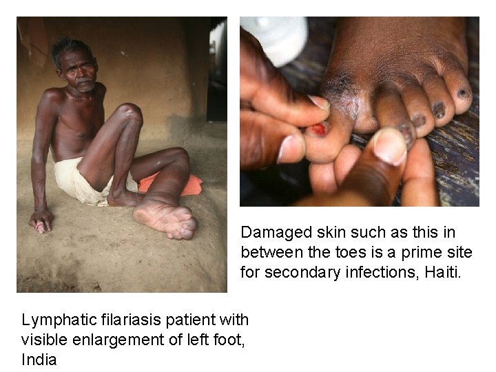 Damaged skin such as this in between the toes is a prime site for