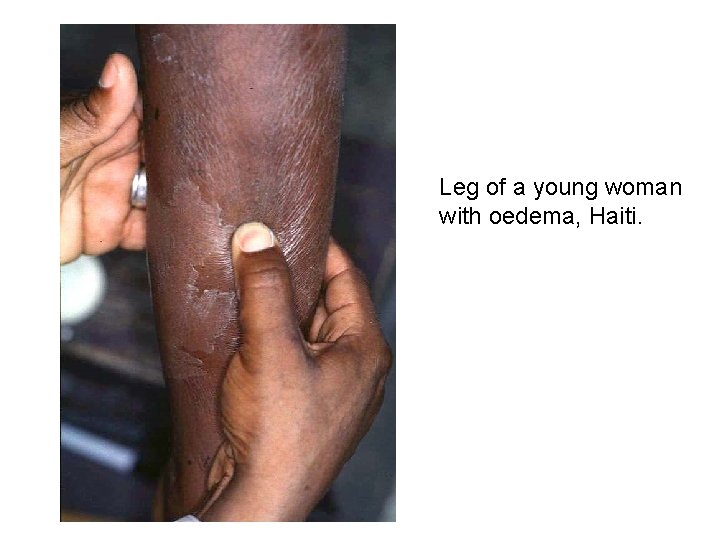 Leg of a young woman with oedema, Haiti. 