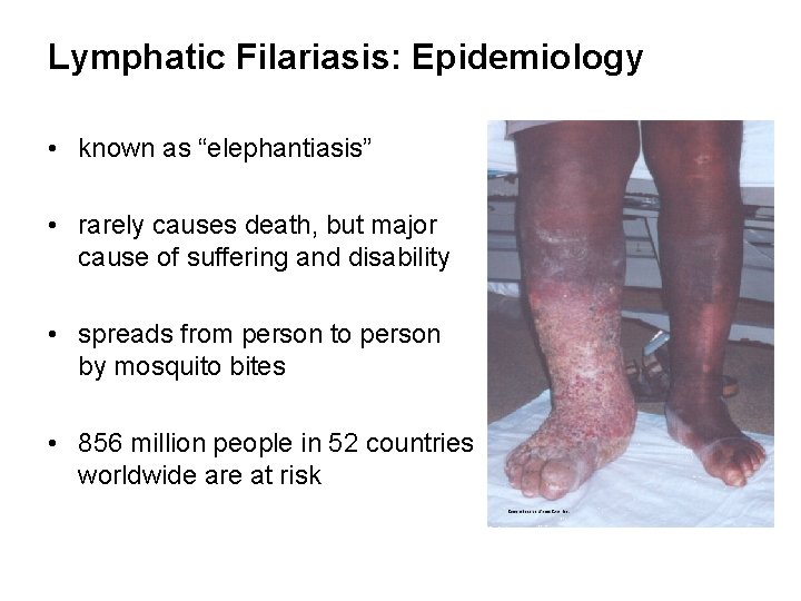 Lymphatic Filariasis: Epidemiology • known as “elephantiasis” • rarely causes death, but major cause
