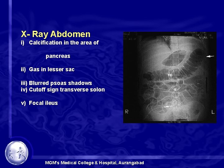 X- Ray Abdomen i) Calcification in the area of pancreas ii) Gas in lesser
