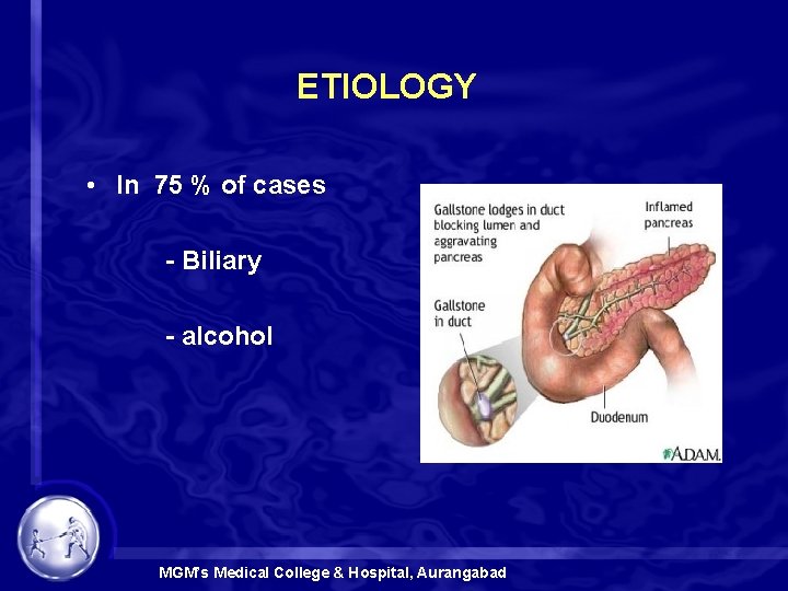 ETIOLOGY • In 75 % of cases - Biliary - alcohol MGM’s Medical College
