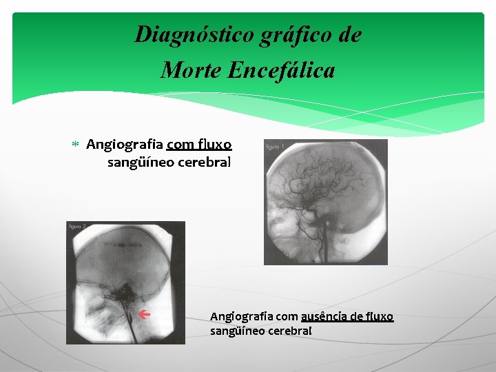 Diagnóstico gráfico de Morte Encefálica Angiografia com fluxo sangüíneo cerebral Angiografia com ausência de