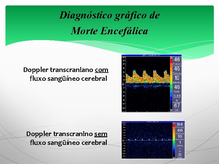 Diagnóstico gráfico de Morte Encefálica Doppler transcraniano com fluxo sangüíneo cerebral Doppler transcranino sem