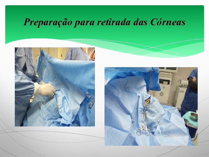 Preparação para retirada das Córneas 