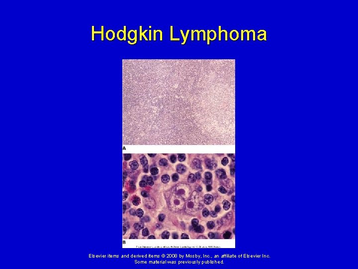 Hodgkin Lymphoma Elsevier items and derived items © 2008 by Mosby, Inc. , an
