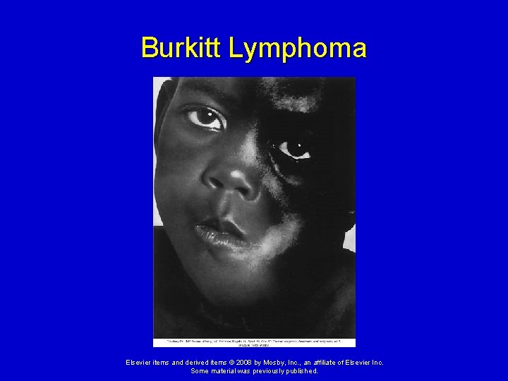 Burkitt Lymphoma Elsevier items and derived items © 2008 by Mosby, Inc. , an