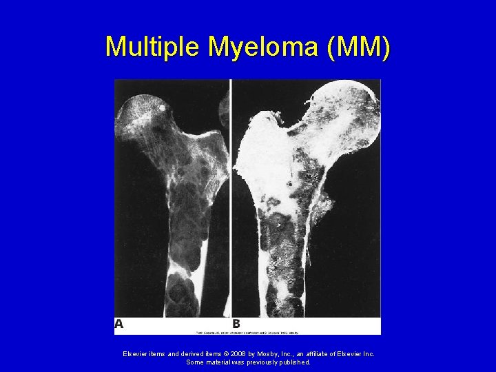 Multiple Myeloma (MM) Elsevier items and derived items © 2008 by Mosby, Inc. ,