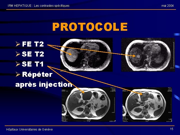 IRM HEPATIQUE : Les contrastes spécifiques mai 2004 PROTOCOLE Ø FE T 2 Ø