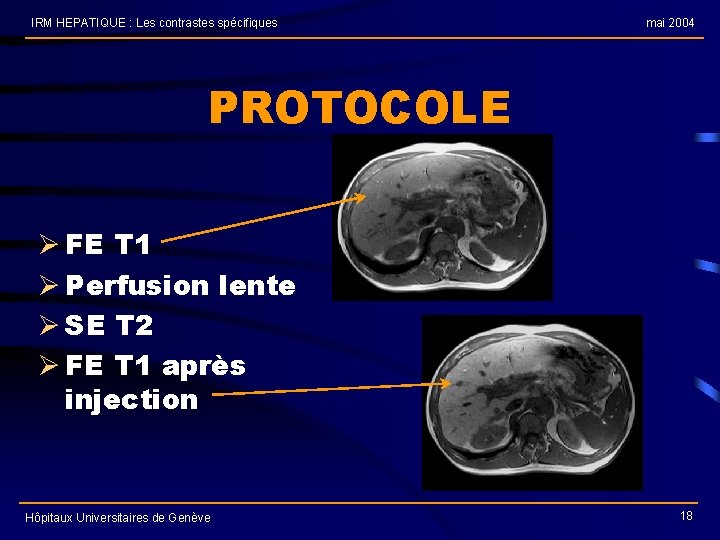 IRM HEPATIQUE : Les contrastes spécifiques mai 2004 PROTOCOLE Ø FE T 1 Ø