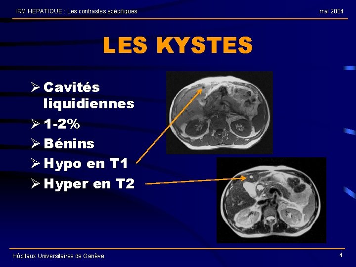 IRM HEPATIQUE : Les contrastes spécifiques mai 2004 LES KYSTES Ø Cavités liquidiennes Ø