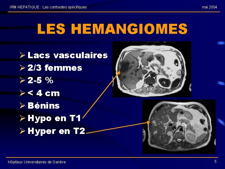 IRM HEPATIQUE : Les contrastes spécifiques mai 2004 LES HEMANGIOMES Ø Lacs vasculaires Ø