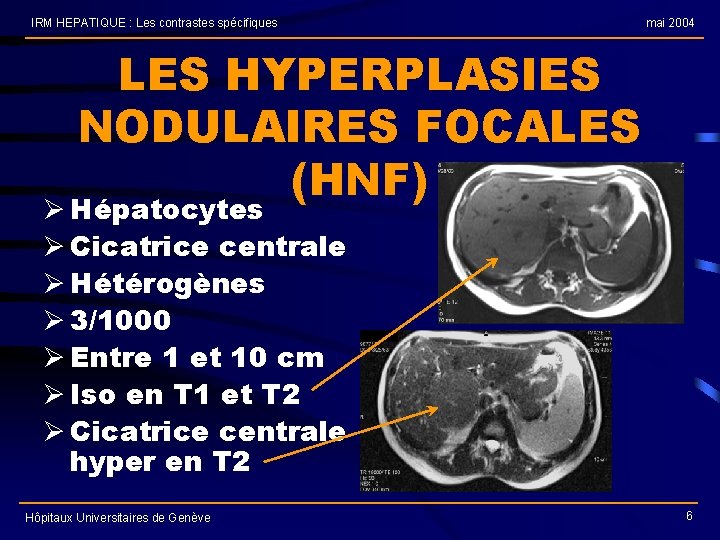 IRM HEPATIQUE : Les contrastes spécifiques mai 2004 LES HYPERPLASIES NODULAIRES FOCALES (HNF) Ø