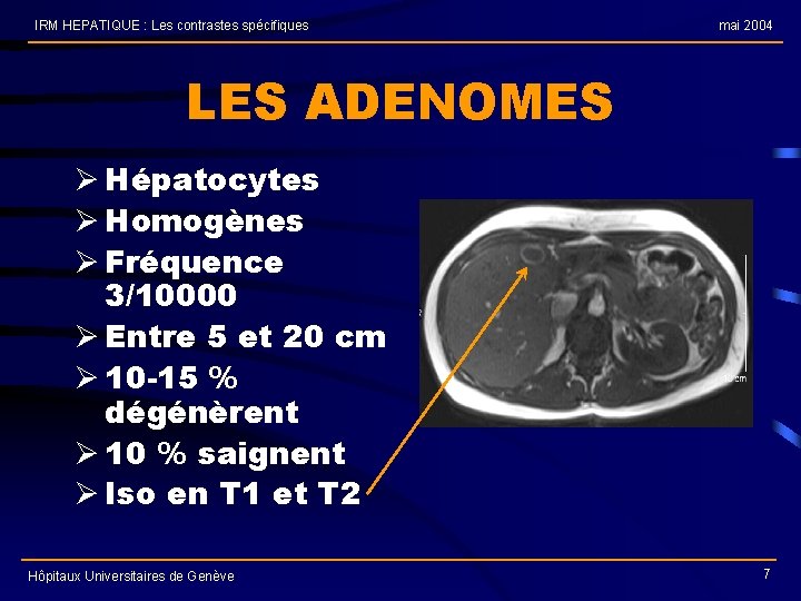 IRM HEPATIQUE : Les contrastes spécifiques mai 2004 LES ADENOMES Ø Hépatocytes Ø Homogènes