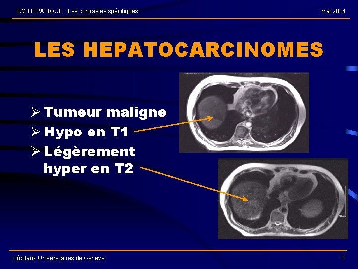 IRM HEPATIQUE : Les contrastes spécifiques mai 2004 LES HEPATOCARCINOMES Ø Tumeur maligne Ø