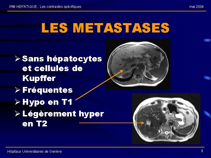 IRM HEPATIQUE : Les contrastes spécifiques mai 2004 LES METASTASES Ø Sans hépatocytes et