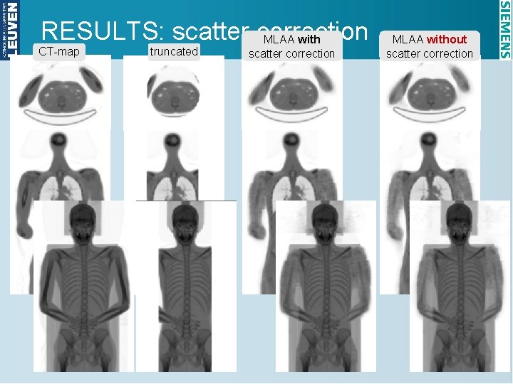 RESULTS: scatter correction MLAA with CT-map truncated scatter correction MLAA without scatter correction 