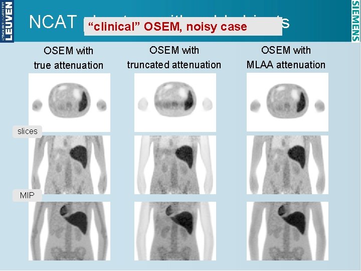 NCAT phantom withnoisy coldcase objects “clinical” OSEM, OSEM with true attenuation slices MIP OSEM