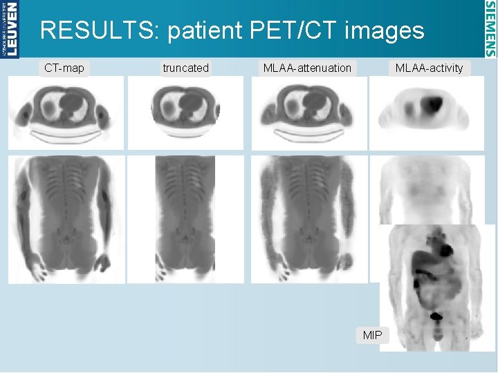 RESULTS: patient PET/CT images CT-map truncated MLAA-attenuation MLAA-activity MIP 