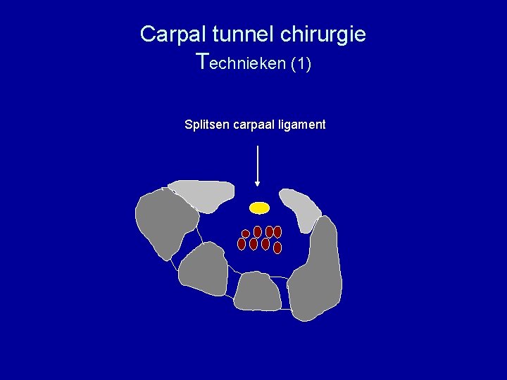 Carpal tunnel chirurgie Technieken (1) Splitsen carpaal ligament 