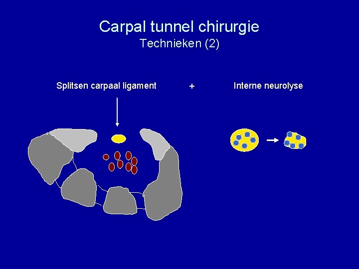 Carpal tunnel chirurgie Technieken (2) Splitsen carpaal ligament + Interne neurolyse 