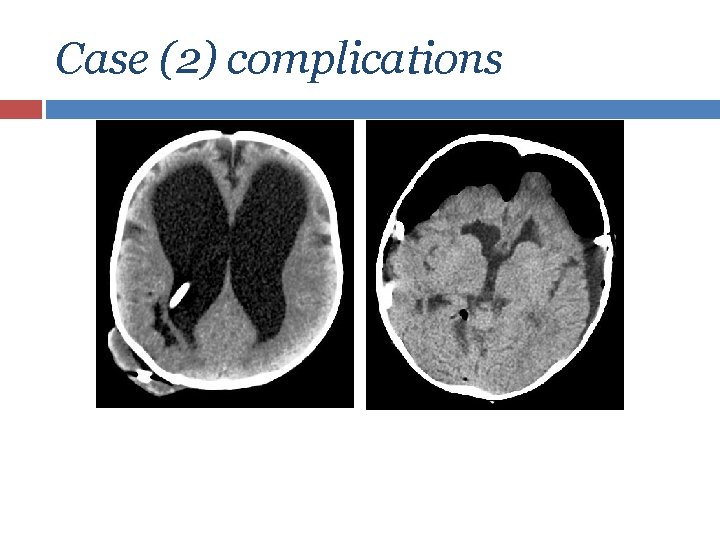 Case (2) complications 
