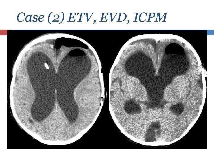 Case (2) ETV, EVD, ICPM 