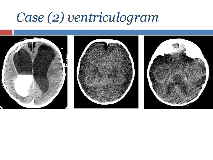 Case (2) ventriculogram 