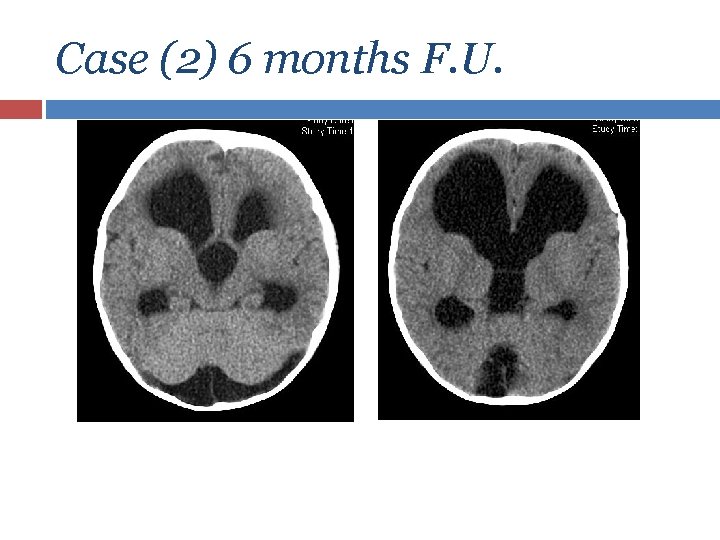 Case (2) 6 months F. U. 