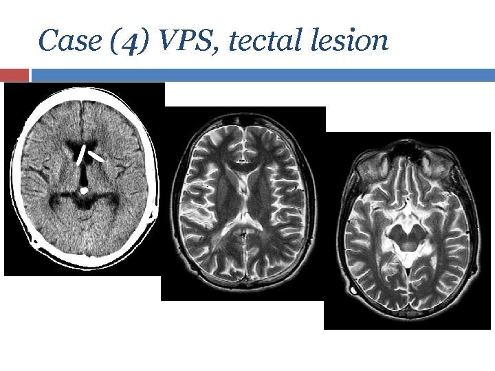 Case (4) VPS, tectal lesion 
