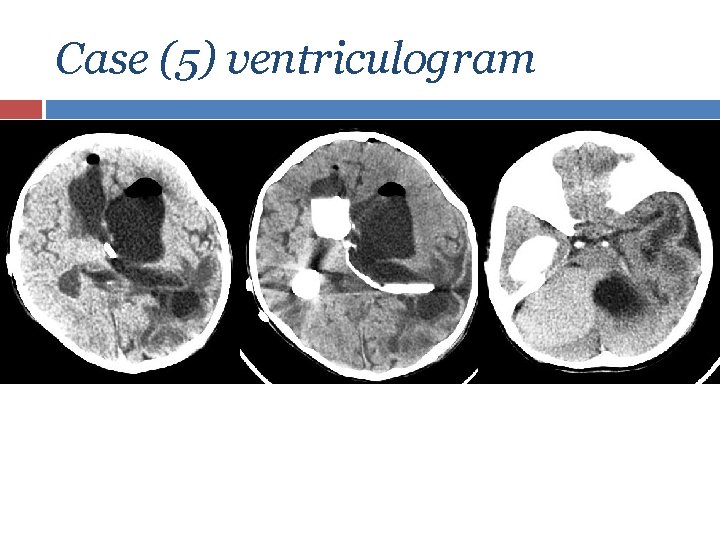 Case (5) ventriculogram 
