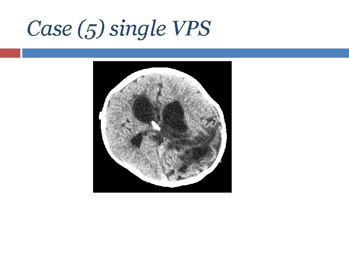 Case (5) single VPS 