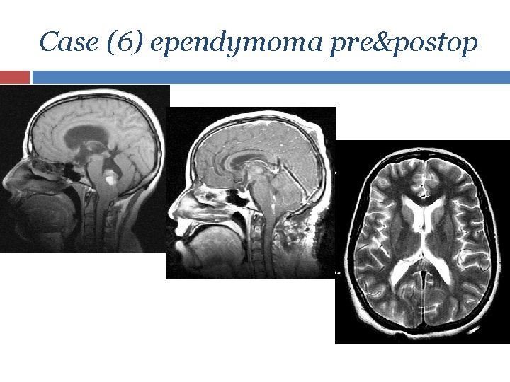 Case (6) ependymoma pre&postop 