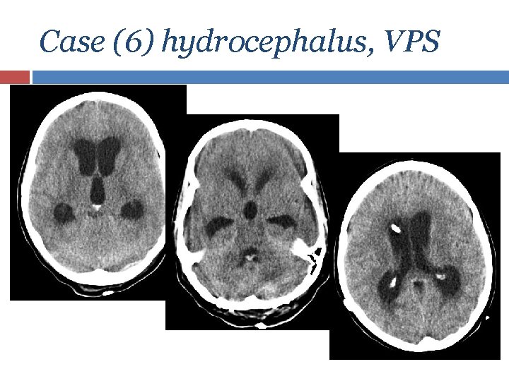 Case (6) hydrocephalus, VPS 