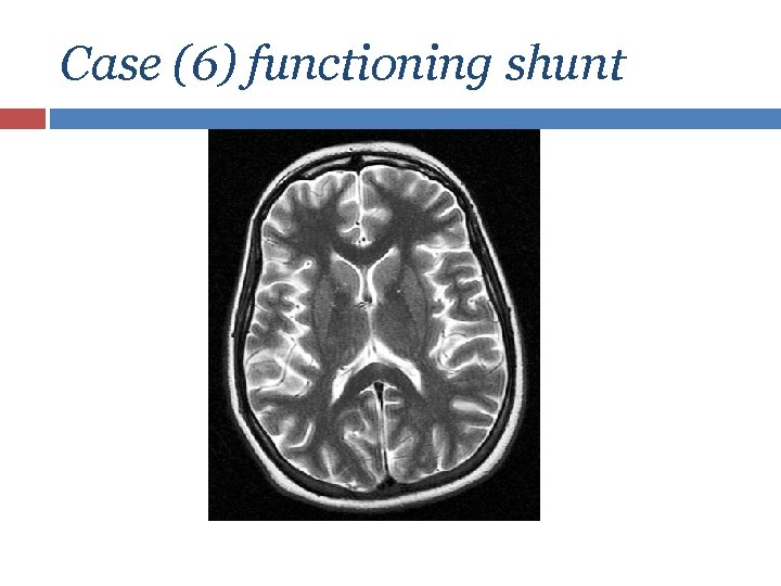 Case (6) functioning shunt 