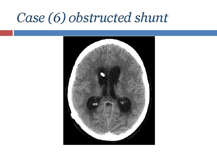 Case (6) obstructed shunt 