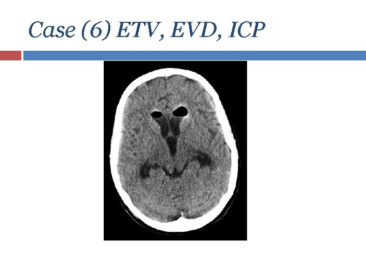 Case (6) ETV, EVD, ICP 