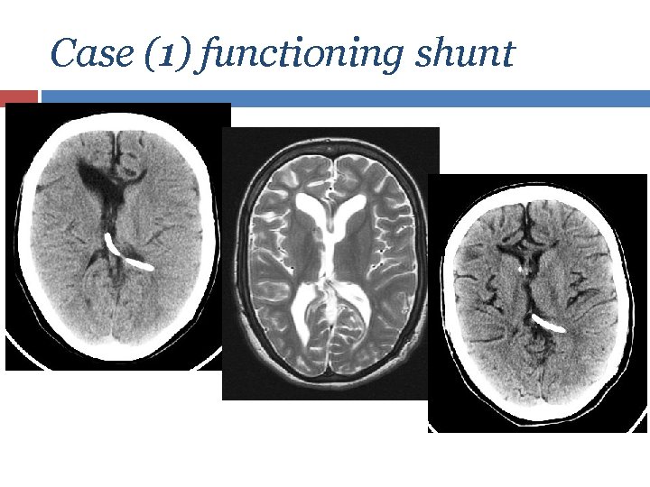 Case (1) functioning shunt 