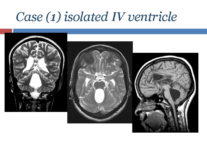 Case (1) isolated IV ventricle 