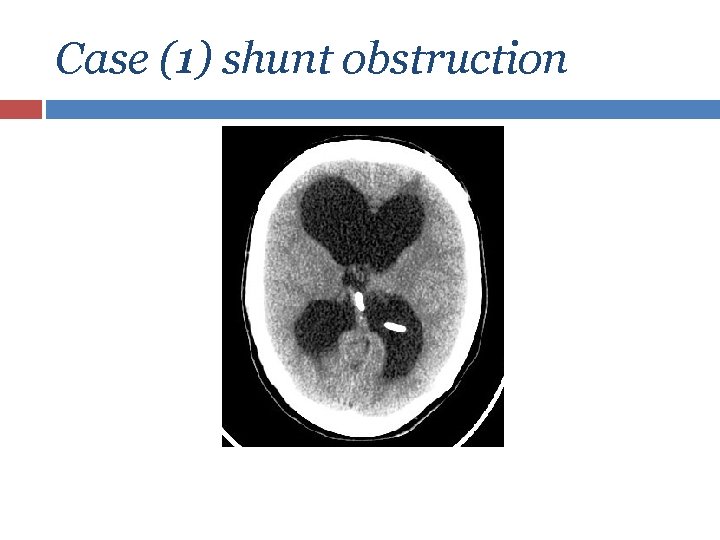 Case (1) shunt obstruction 