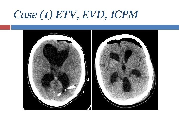Case (1) ETV, EVD, ICPM 