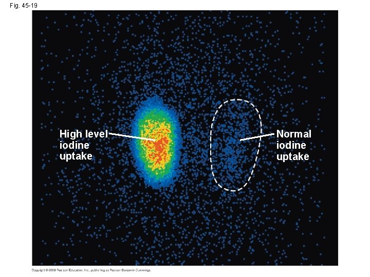 Fig. 45 -19 High level iodine uptake Normal iodine uptake 