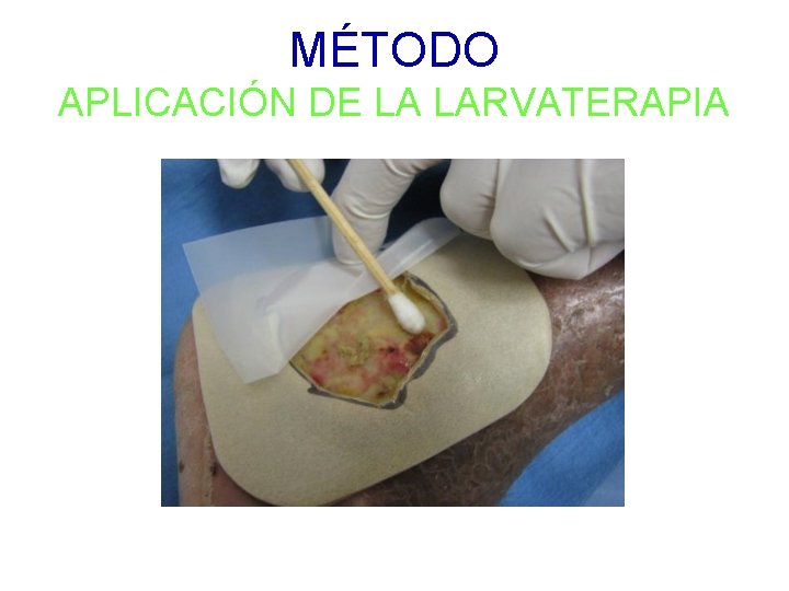 MÉTODO APLICACIÓN DE LA LARVATERAPIA 