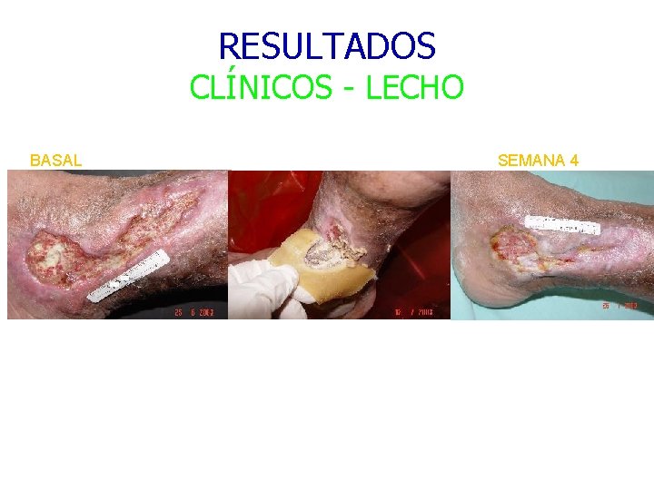 RESULTADOS CLÍNICOS - LECHO BASAL SEMANA 4 