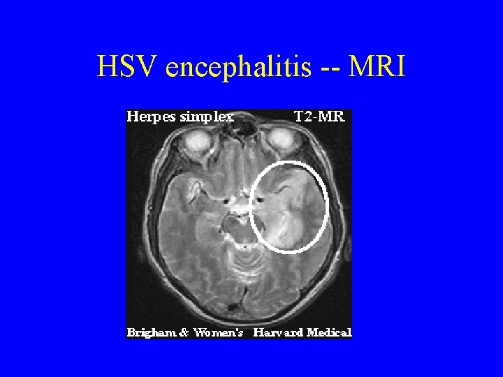 HSV encephalitis -- MRI 