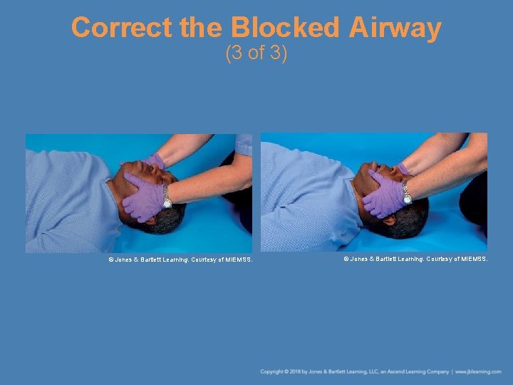 Correct the Blocked Airway (3 of 3) © Jones & Bartlett Learning. Courtesy of