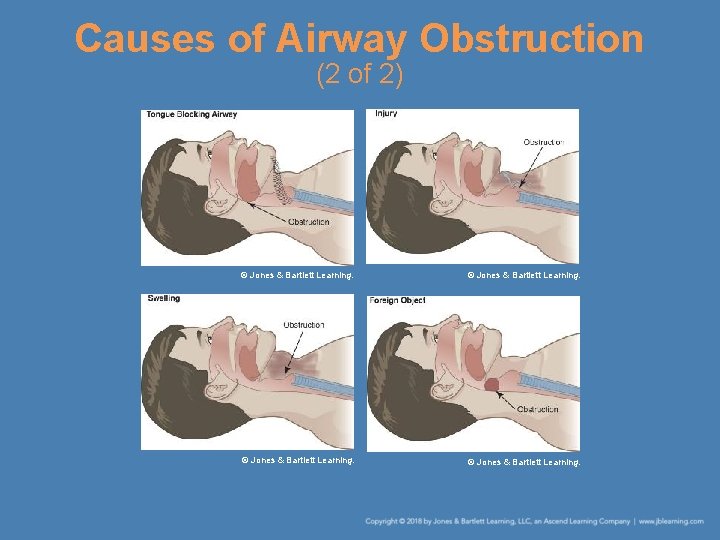 Causes of Airway Obstruction (2 of 2) © Jones & Bartlett Learning. 